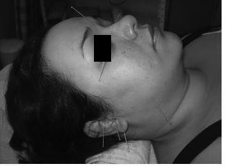 Borin et al. Acupuntura na isfunção temporomandibular (R10). A coleta dos dados e a aplicação da acupuntura foram realizadas pelo mesmo pesquisador.
