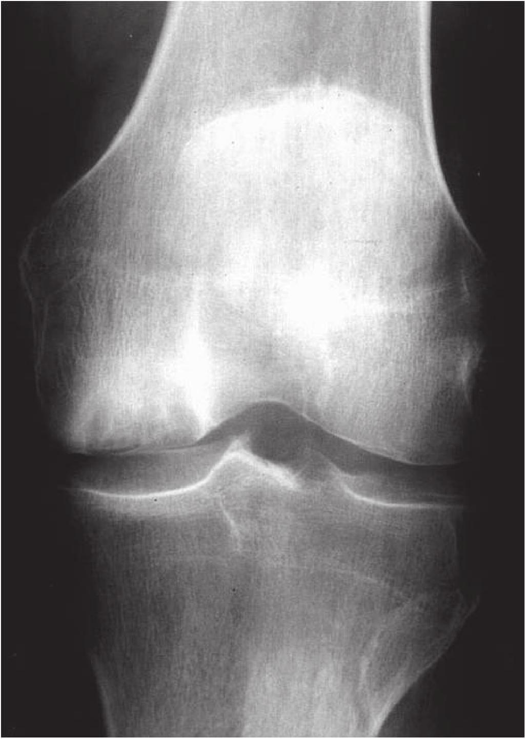A RM demonstra edema ósseo e em alguns casos há sinais de traço de fratura (figura 4), que é favorável à etiologia traumática da OIJ (6).