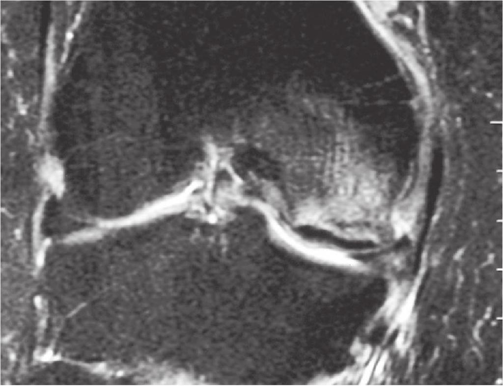 O exame radiográfico pode apresentar imagem do traço de fratura (figura 5), porém a RM é conclusiva, demonstrando o traço da fratura e o edema.