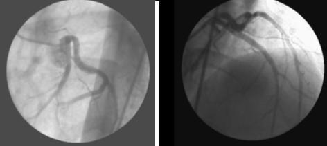 O paciente foi submetido a angioplastia primária com colocação de stent não farmacológico com sucesso obtendo-se recuperação total de fluxo na artéria