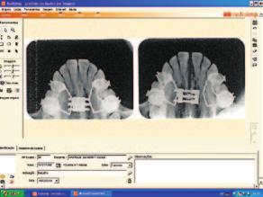 Avaliação e mensuração da sutura palatina mediana por meio da radiografia oclusal total digitalizada em pacientes submetidos à expansão rápida maxilar 10mm a B C 3mm D Figura 1 - Segmentos anatômicos