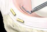 9 10 a Use o passador de sutura para inserir a sutura externa através da ponta do empurrador de nó/cortador de sutura. Empurre o nó ao aplicar tensão na extremidade livre da sutura.