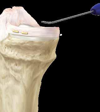 Pressione o gatilho da alça do empurrador de nó/cortador de sutura para cortar a sutura. Puxe a sutura firmemente.
