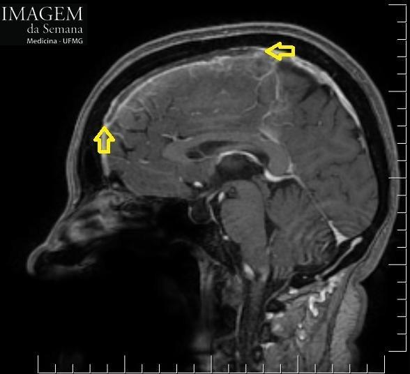 Imagem 2: RM de crânio, ponderada em T1, corte sagital, pós-contraste, mostrando falha de