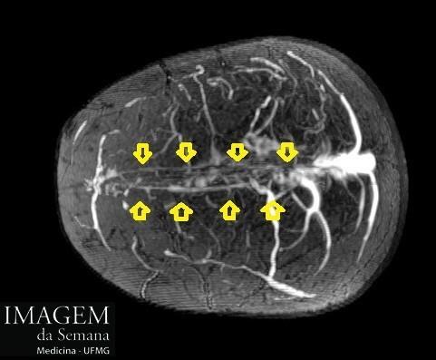 Imagens 3 e 4: Angiorressonância de crânio, corte axial e sagital, fase venosa, evidenciando ausência de fluxo sanguíneo nos terços proximal e médio do