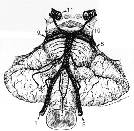 Sistema Vértebro-Basilar Ramos: 1 A. Vertebral direita 2 A. Vertebral esquerda 3 A. Espinhal anterior 4 A. Cerebelar póstero-inferior (PICA) 5 Junção das vertebrais => A.