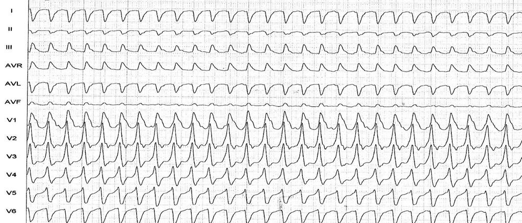 Resultados 39 Figura 8 Taquicardia Ventricular diagnosticada de acordo com o critério novo, baseado no seu Passo 2 (derivação D1, D2 e V6 com polaridade com predominância negativa). 4.