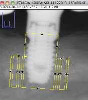 diferentes daqueles realizados nas imagens radiográficas (Figura 11).