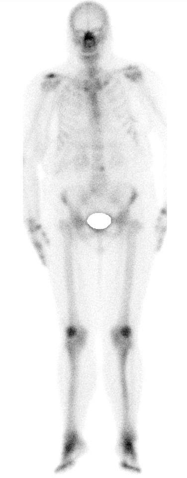 Para as lesões osteolíticas a FDG-PET tem maior sensibilidade que a cintigrafia óssea o que leva a pensar que uma