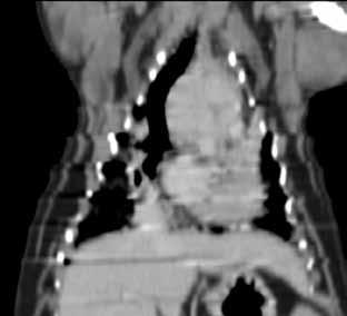 Cardiomegalia e massas de base no coração Difícil diferenciar efusão pericárdia