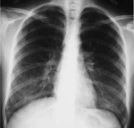 Foi assim diagnosticada alveolite alérgica extrínseca, com evicção das aves domésticas e proposta corticoterapia sistémica, que a doente recusou. Melhoria clínica ligeira.