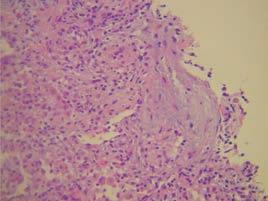 Realizou broncofibroscopia que não mostrou alterações endobrônquicas; o estudo do LBA em termos microbiológicos foi negativo e a análise imunológica mostrou uma alveolite linfocítica com 72% de