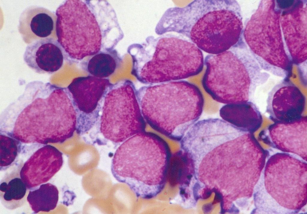 Leucemia mieloide