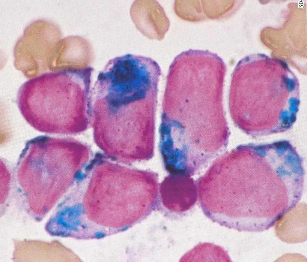 Leucemia mieloide