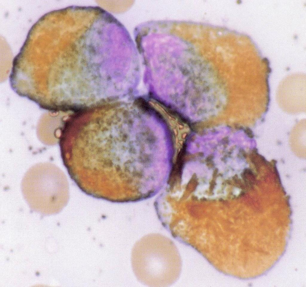 Leucemia promielocítica