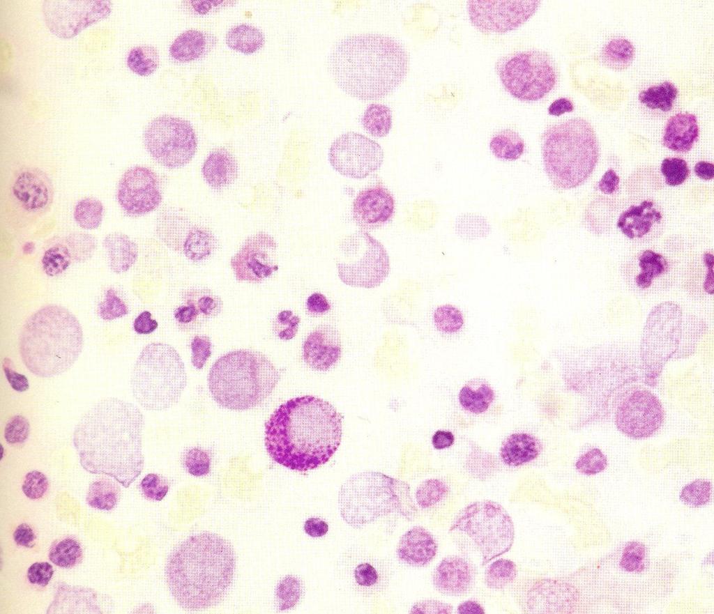 Eritroleucemia (LMA M6a) e