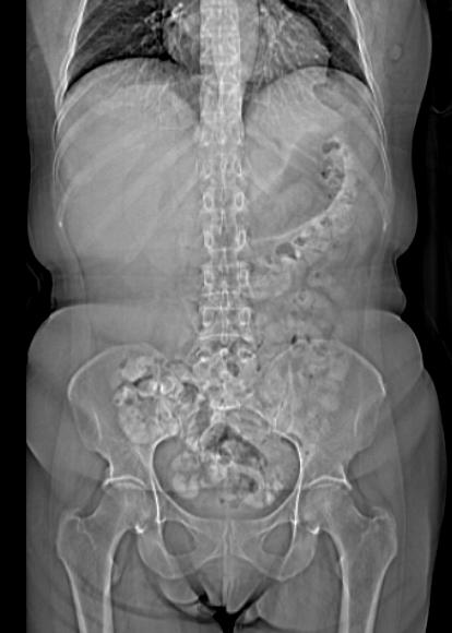 Raios-X simples Ultra-sonografia