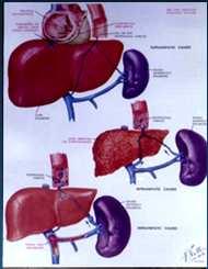 Sinais de hipertensão portal Ascite Esplenomegalia Colaterais venosas
