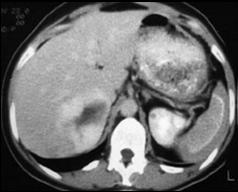 hepática congênita, doença policística) Cistoadenoma hepatobiliar