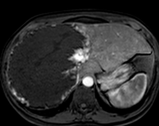 gigante Hemangioma Neoplasias hepáticas malignas primárias Tumores