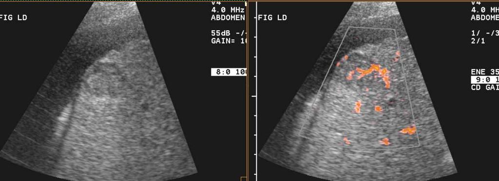 arterio-venosos CHC Curva de reforço pós-cont (TC e RM dinâmico) Confirmação diagnóstica Lesão focal > 2 cm com hipervascularização arterial (US,