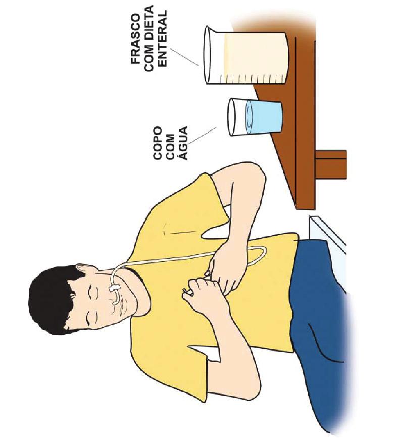 Tampar a sonda; Lavar, com água e sabão ou detergente, a seringa e os recipientes utilizados; após, passar água fervente; Secar e guardar a seringa num recipiente fechado, dentro da geladeira 2.