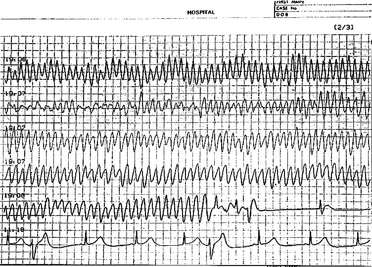 Holter ECG Recording in LQTS Patient with Syncope