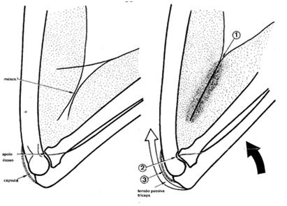 Limitação de movimento Extensão Flexão ativa e passiva Articulações Rádio-ulnares Proximal e Distal Incisura radial Incisura ulnar Articulações Rádio-ulnares Proximal e Distal Sindesmose