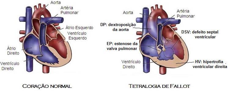 TERATOLOGIAS CARDÍACAS Tetralogia de Fallot Defeito cardíaco cianótico