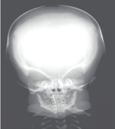 Diagnóstico pré-natal de displasia tanatofórica: papel do ultrassom fetal A avaliação radiográfica mostrou crânio com grande diâmetro transverso, face com dimensões reduzidas, tórax de menor