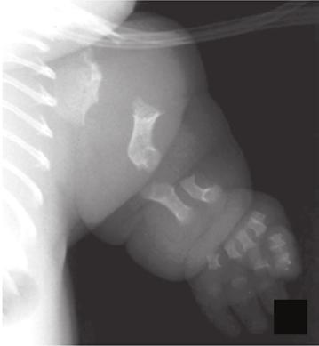 inferiores (os fêmures eram curvos) e hipoplasia da bacia (Figura 3). A soma dos achados clínicos e radiológicos confirmou o diagnóstico gestacional de displasia tanatofórica.