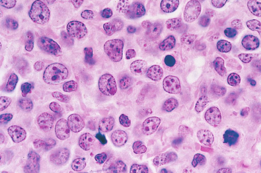 fungoide avançada. Figura e17.50 Linfoma difuso de grandes células B em um linfonodo.