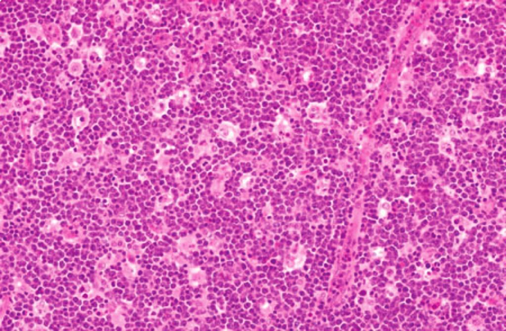 cromatina vesicular e nucléolos proeminentes. Figura e17.48 Leucemia de células T do adulto.