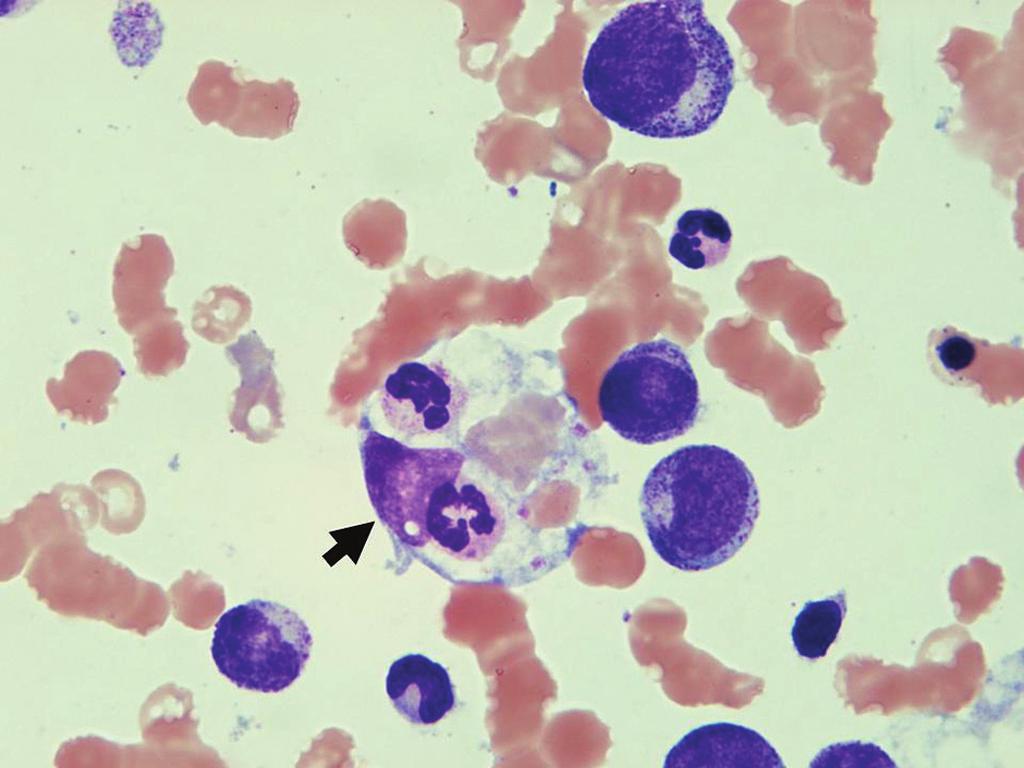 CAPÍTULO e17 Figura e17.52 Eritrofagocitose associado a linfoma agressivo.