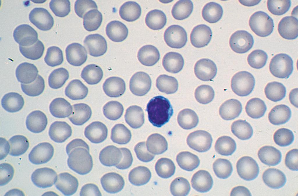 PARTE II Principais Manifestações e Apresentações das Doenças 17-2 membrana celular; entretanto, são também observados na deficiência de ferro, nas síndromes mielodisplásicas, na anemia