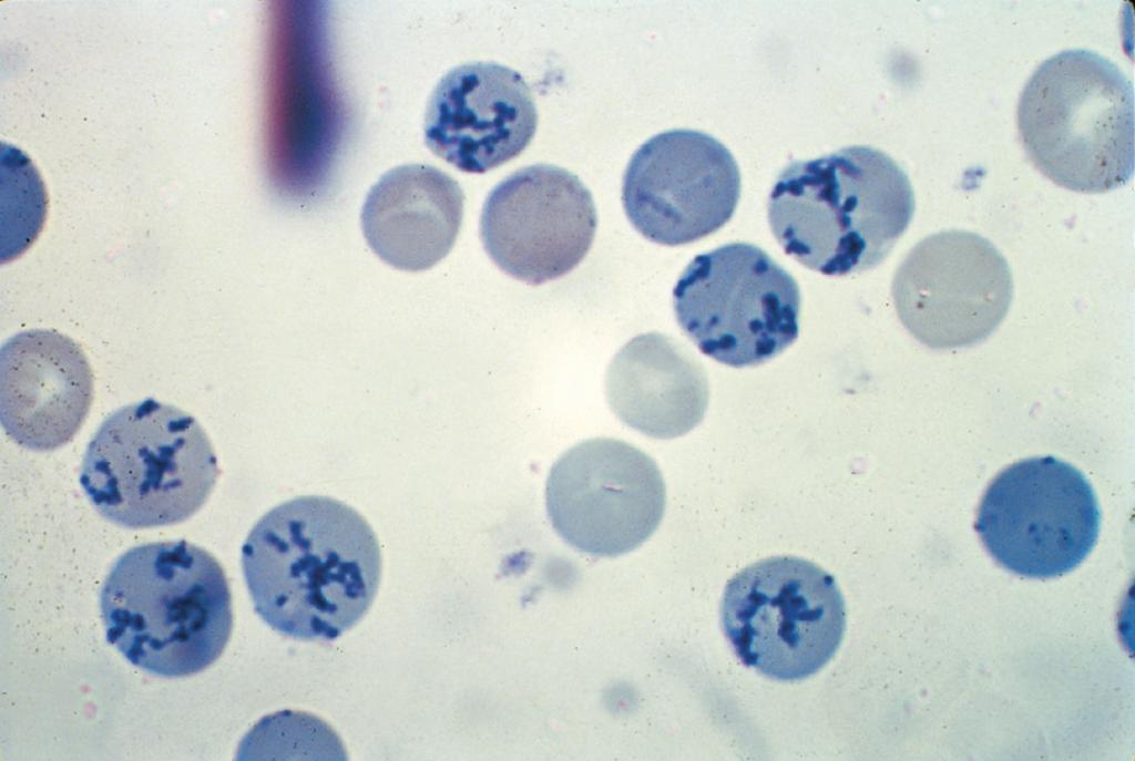 Os estomatócitos podem indicar um defeito herdado da membrana celular do eritrócito e também podem ser observados no alcoolismo.