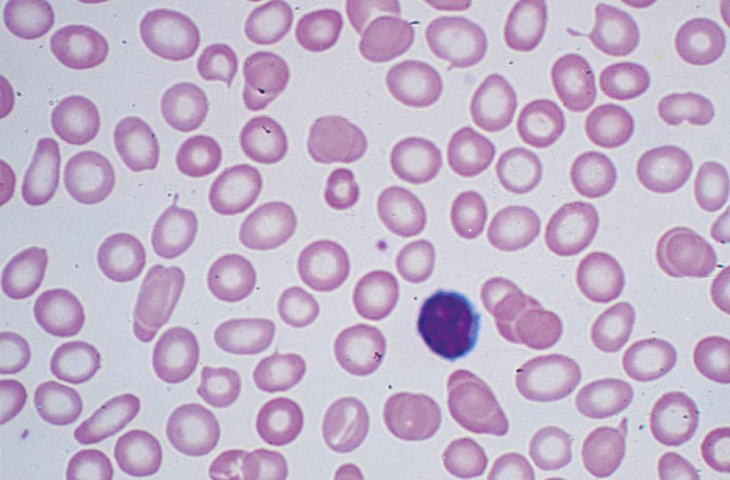 Essas células são observadas classicamente na talassemia, mas também podem estar presentes na deficiência de ferro, na doença hepática colestática e em algumas hemoglobinopatias.