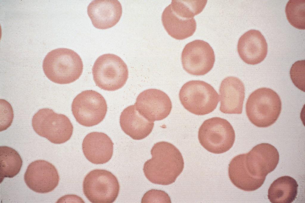A presença de números maiores é típica da doença da hemoglobina C. Figura e17.