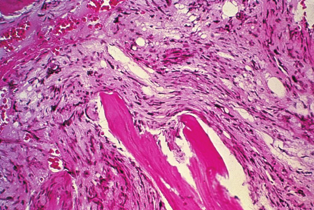 Um eritrócito em forma de lágrima (à esquerda) e um eritrócito nucleado (à direita), observados na mielofibrose e hematopoiese extramedular.