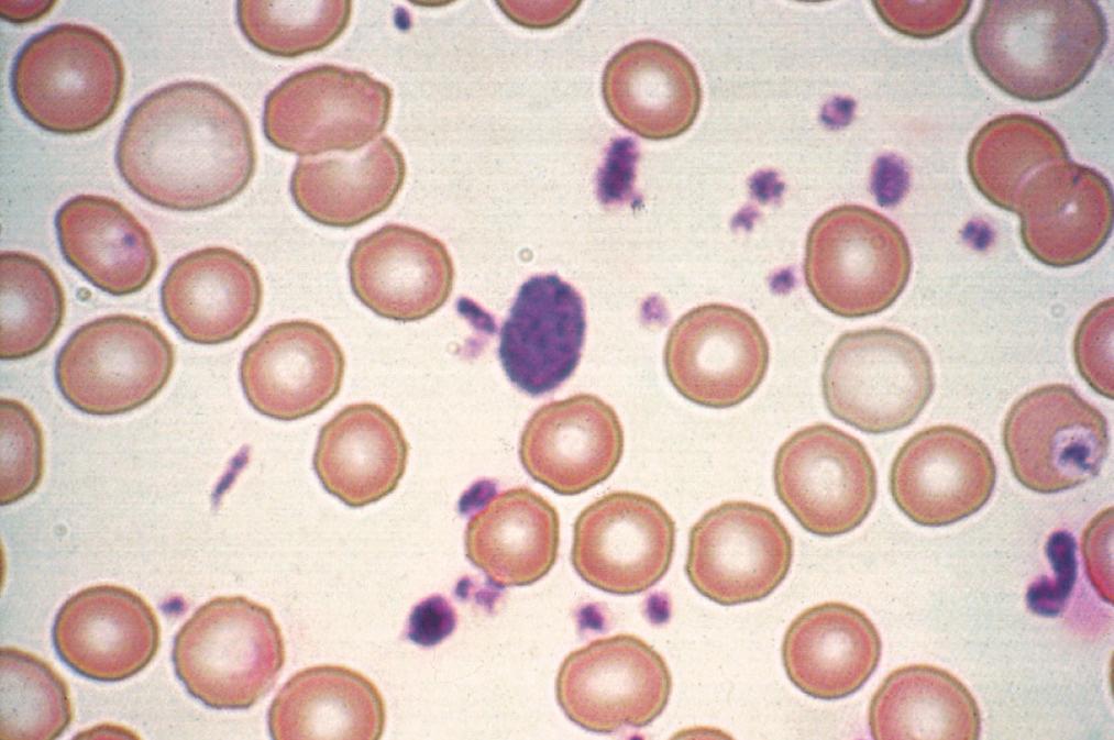 O material corado consiste em precipitados de hemoglobina desnaturada dentro das células.