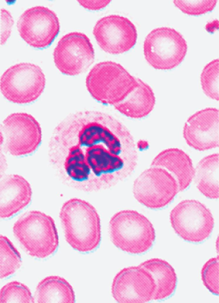 As plaquetas gigantes, juntamente com um aumento acentuado da contagem plaquetária, são