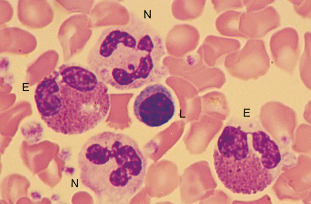 N, neutrófilo; E, eosinófilo; L, linfócito. Figura e17.24 Granulócitos normais.