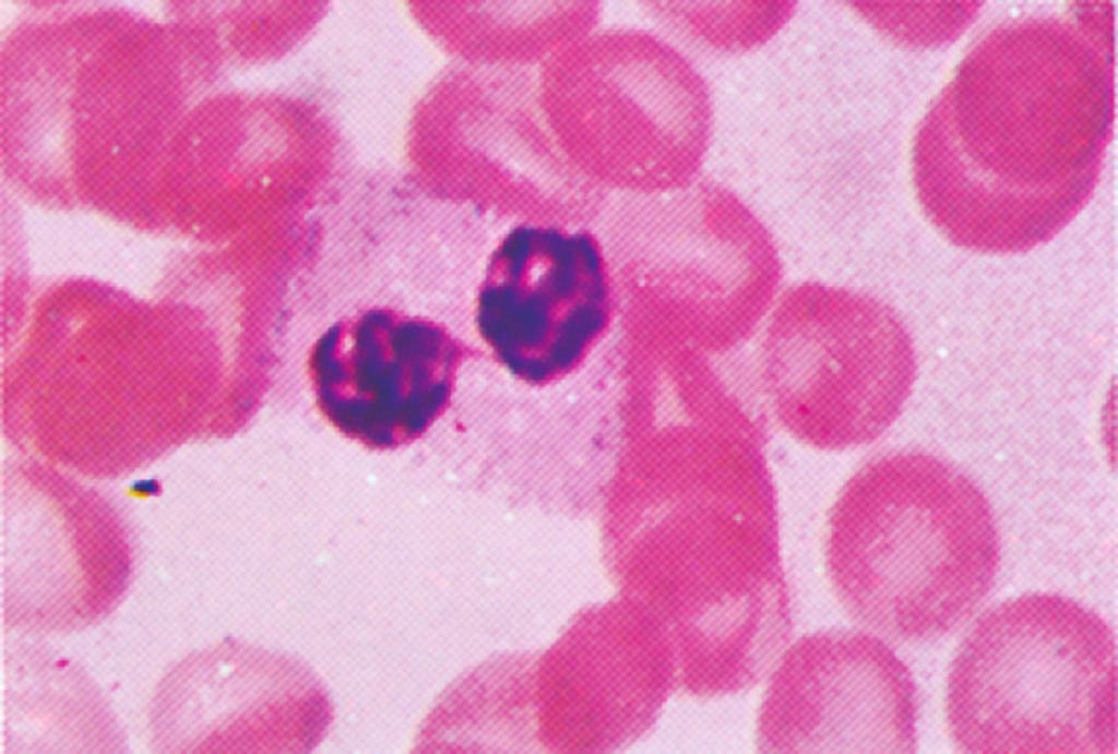 Figura e17.30 neutrófilo. Doença de Chédiak-Higashi. Observe os grânulos gigantes no Figura e17.32 Medula óssea na anemia aplásica.