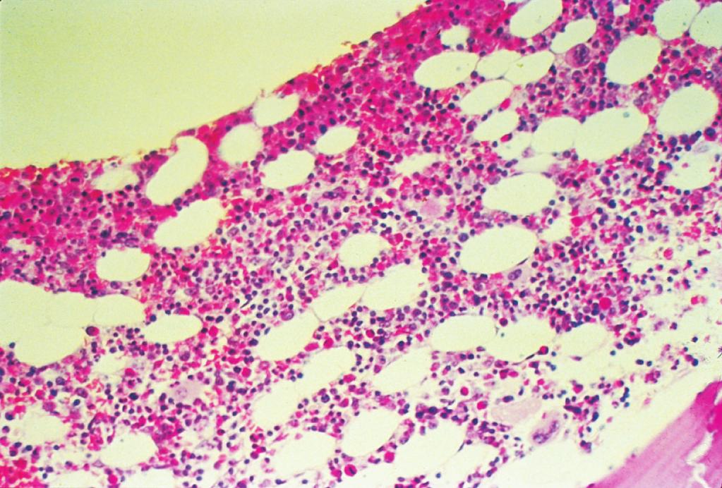 Vista com baixo aumento da medula óssea normal de adulto (coloração pela H&E), mostrando uma mistura de células gordurosas (áreas claras) e células