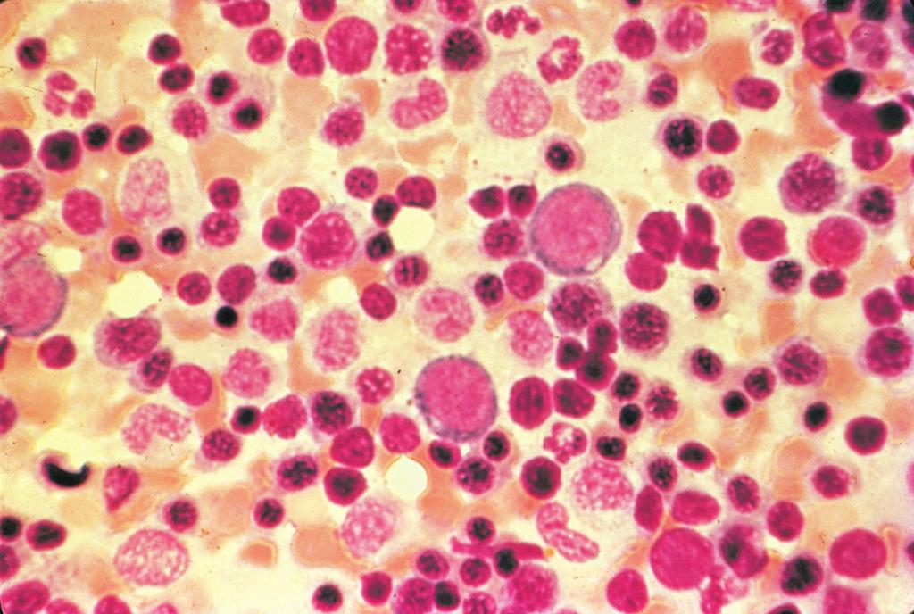 Observe a localização paratrabecular característica das células do linfoma.