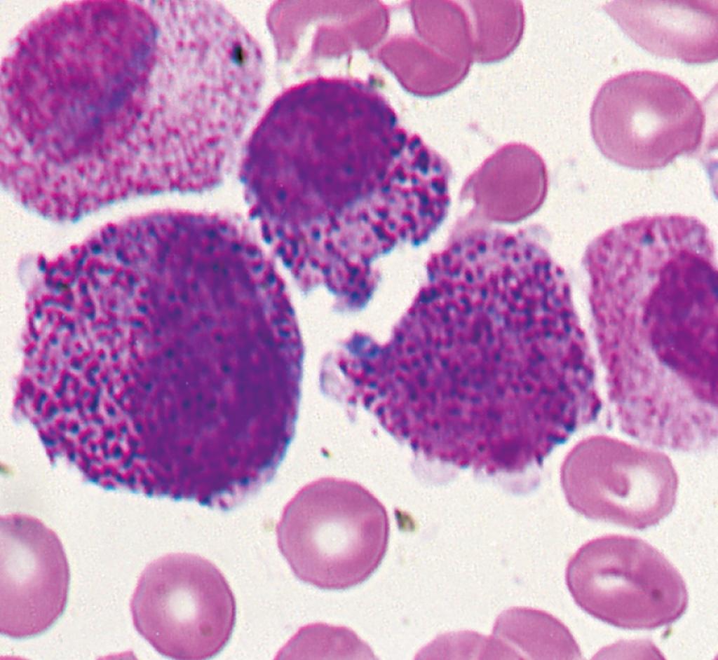 45 Leucemia mieloide crônica no sangue periférico.