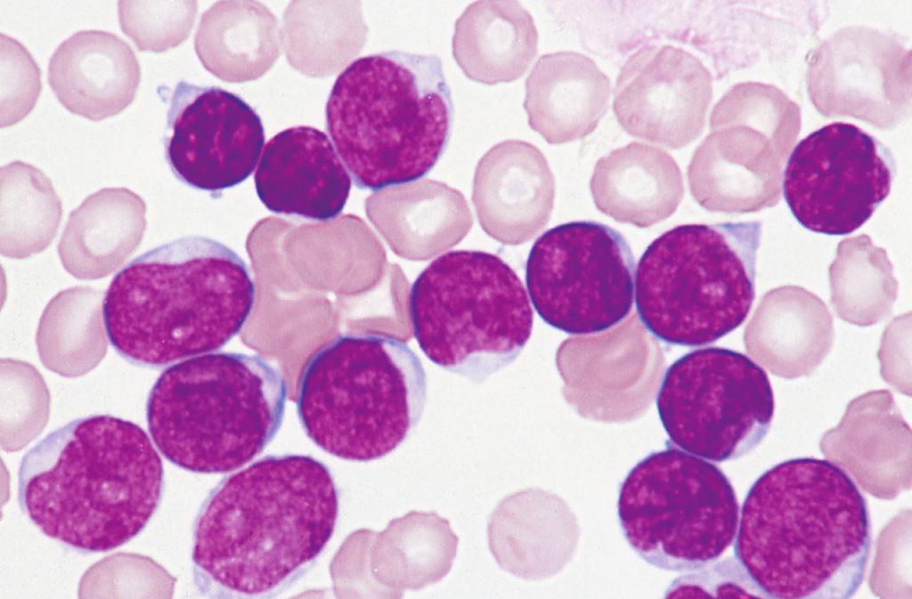 cada célula. 41 Leucemia promielocítica aguda.