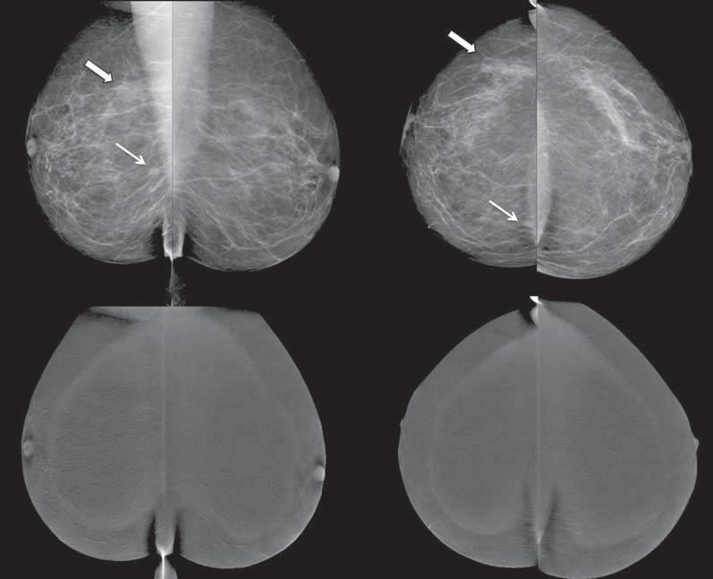 Figura 1. Mamografia digital com contraste de uma mulher com 65 anos de idade.