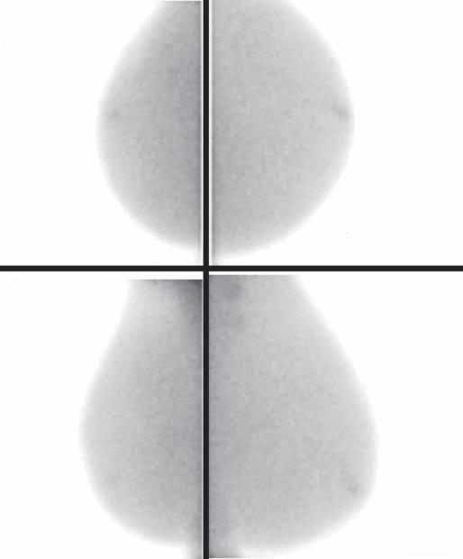 Figura 3. Imagem molecular mamária de uma mulher com 59 anos de idade que apresentava mamografia inconclusiva com mamas densas (BI-RADS 0).