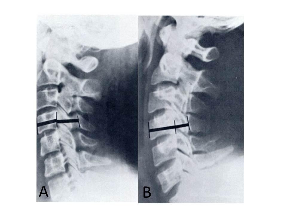 2 Revisão da Literatura 20 FONTE: Torg et al. (1986) 5. Figura 4 Exemplos de radiografias de um canal cervical normal (A), com índice de Torg de cerca de 1.